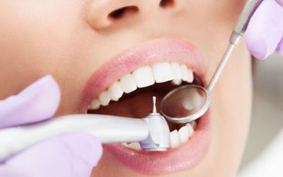 Dental Fillings: What You Need to Know